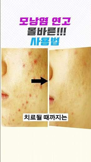 모낭염에 효과보는 연고사용법❗️#모낭염 #피부관리 #skincare #에스로반