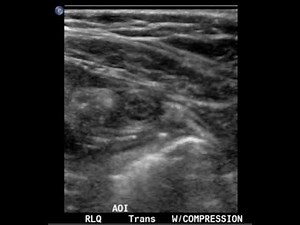 Appendicitis, Ultrasound Transverse with Compression. JETem 2017.