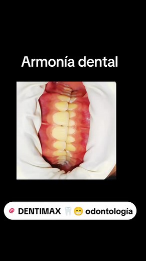 #CapCut ✨ Armonía dental en DENTIMAX: La sonrisa perfecta a tu alcance ✨ Transforma tu sonrisa con tratamientos que equilibran estética y salud. En DENTIMAX, logramos la armonía dental que tanto deseas, con un cuidado detallado y personalizado para que luzcas radiante. 📞 Contáctanos al 3115774800 y agenda tu cita hoy. 📍 Te esperamos en Villavicencio. transversal 27#40-24 Emporio #DENTIMAX #EstiloUnico #saluddentsl #cordales