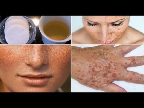 VOICI COMMENT ENLEVER NATURELLEMENT LES TACHES BRUNES SUR LES VISAGES ET LES MAINS