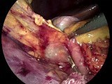Laparoscopic Right Colectomy - Step III   IV • Video • MEDtube.net
