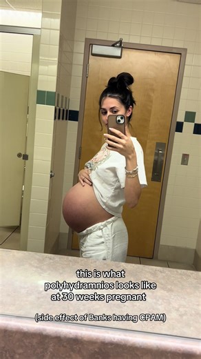 Understanding Polyhydramnios and Amnioreduction in Pregnancy