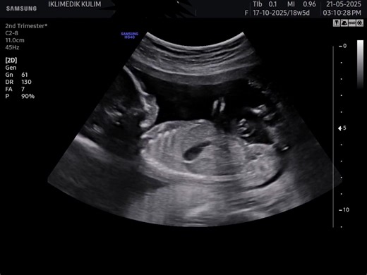 18week baby ❤️ #ultrasound #sonobeeultrasoundmalaysia #fyp #pregnancy