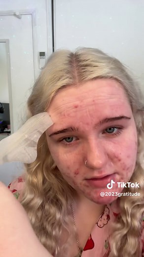 Skin control never fails to impress me💕 This isnt an ad or anything i just genuinely love skin control and how well it works!✨ @Skin Control AU 💞 #skincontrol #skincontrolpimplepatches #pimple #pimplepop #pimplepatch #pimplepatchremoval #pimplepatchpeel #pimplepatchresults #acne #acneproneskin #fyp #australia