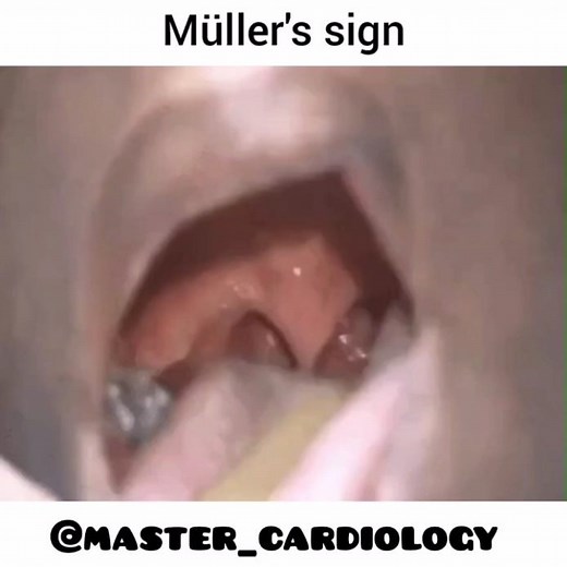 🔺Master_Cardiology🔺 | ⭕Müller's sign is the pulsation or bobbing of the uvula that occurs during systole. It can be seen in patients with severe aortic... | Instagram