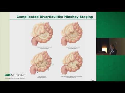 Diverticulitis: To Operate or Not?