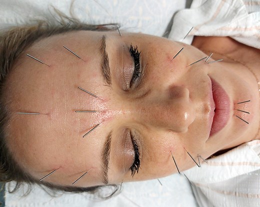 Acupuncture | Cabinet Acupuncture Nguyen