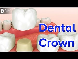 Dental Crown | Types, Procedure, Material