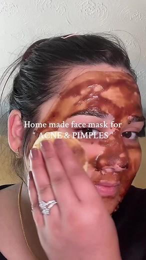 Effective Face Mask for Acne and Pimples