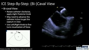 ICE Imaging for PFO and ASD Closure
