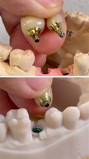 Zirconia crowns that we completed in my lab today