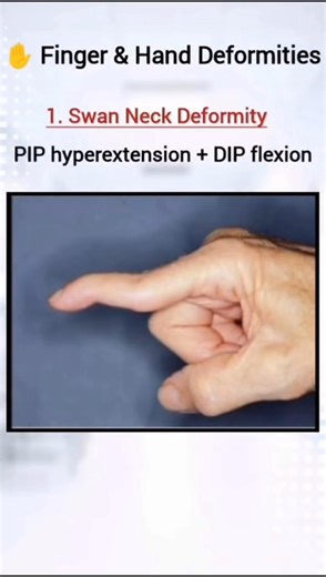 Common Hand🖐️ & Finger Deformities Explained (Causes & Symptoms) #anatomy #physio #physiotherapy