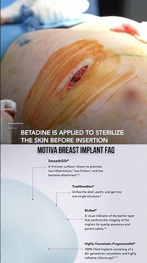 Transgender MTF Top Surgery (Breast Augmentation) with Motiva Implants! Dr. Rahal shows all!