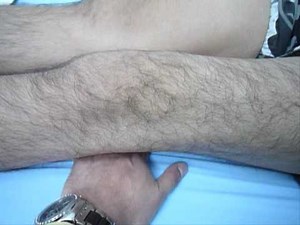 Expanse Lag Prophylaxis After Anterior Cruciate Ligament Reconstruction • Video • MEDtube.net