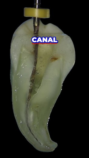 8.9K views · 45 reactions | These glide path files are fantastic for shaping canals! Use sizes 10, 15, or even 20. They shape teeth quickly and help avoid ledges. Remember to recapitulate to keep the canal open. Game changer for your practice! #GlidePath #Endodontics #DentalFiles #CanalShaping #Dentistry | i_love_the_pulp | Facebook
