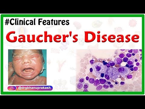 Gaucher's Disease: Etiology, Types, Clinical Features, Pathogenesis, Diagnosis, and Treatment