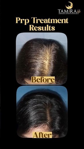 PRP Hair Restoration Before - After | Tamira Life | Chennai