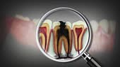Infected root canals showing on molar tooth. Medically accurate tooth...