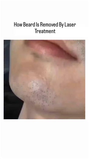 Science on Instagram: "Laser beard removal is a modern, effective method to reduce or permanently remove facial hair. This treatment targets the hair follicles using concentrated beams of light. The laser heats and destroys the follicle, preventing future hair growth. It's a quick, relatively painless procedure that requires multiple sessions for best results. Ideal for those tired of daily shaving or dealing with razor burns, laser treatment offers a clean, long-term solution to unwanted beard 