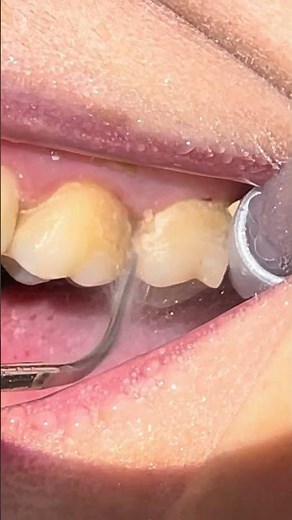 The Most Satisfying Dental Cleaning You’ll See Today 😍 #asmr #satisfying #dentist