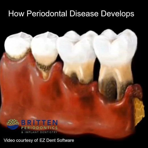 🦷 How Does Gum Disease Lead to Tooth Loss?🎥