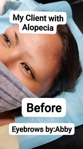 43K views · 512 reactions | Client nako na naay Alopecia:Hair loss...