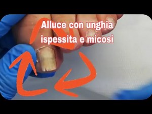 Alluce con unghia ispessita e micosi! Guarda come ho trattato quest'unghia😉
