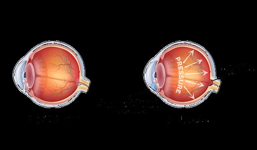 Minimally Invasive Glaucoma Surgery (MIGS) in Singapore | Dr Chelvin Sng