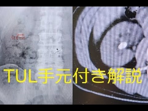 手元動画付き！ TUL ゆっくり解説動画④