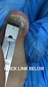 2.8K views | The Ultimate Guide to Ingrown Toenail Removal Pedicure #Reels | Atlas Professional Risk Management | Facebook