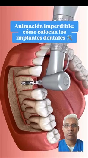 Animación. Como se colocan los implantes dentales 🦷Kit de dentadura postiza 👇👇👇 https://amzn.to/4nXsKIv | DrEglis Dentista