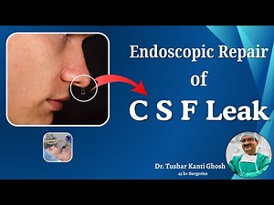 Endoscopic CSF Leak Repair Procedure | By- Dr. Tushar Kanti Ghosh | Ghosh ENT Foundation |