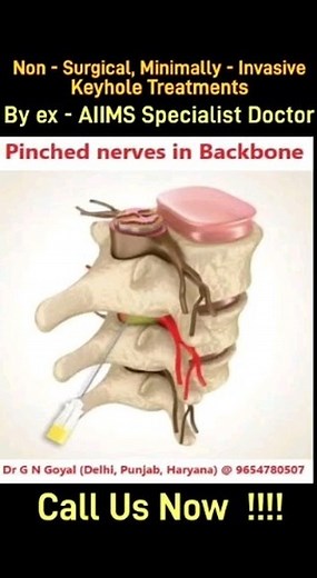 Pinched nerves in backbone is a very common problem and most patients suffer with this pain & problem for weeks, months and sometimes even years. And don’t get relieved even after taking treatment from many doctors. It is important to understand that when nerves are pinched in backbone, then it cannot be cured with medicines ; Because of this some patients fear that the legs may become paralyzed and they undergo unnecessary operation. Now no surgery is needed but many modern and safe, minimally 