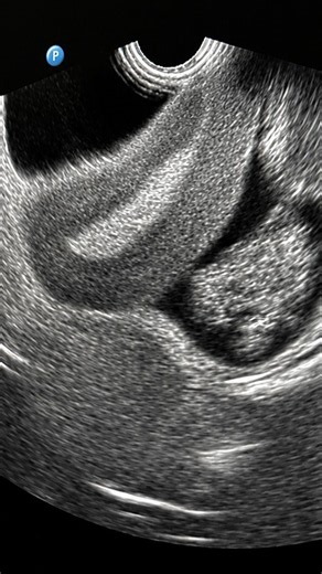 Pelvic Ultrasound Anatomy: A Transvaginal Approach