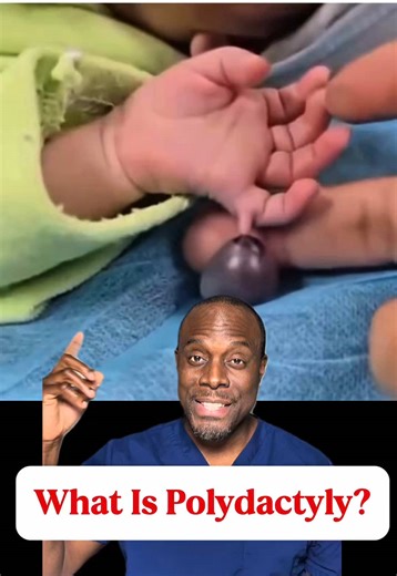 That little extra finger on the pinky side? It’s called polydactyly. There are actually 3 types depending on where it shows up, and the one you’re seeing here is the most common. Some are just small soft tissue attachments, others are fully formed digits, and that determines how they’re treated. #MedScienceSimplified #DrZikkyExplains #AnatomyFacts #PediatricHealth #MedicalEducation Disclaimer: This content is for educational purposes only and is not intended to substitute for professional medica