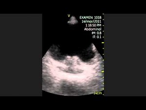 Bladder Diverticulum • Video • MEDtube.net