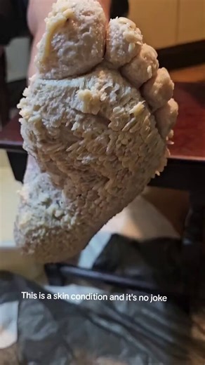 Palmoplantar Keratoderma (PPK) is a rare group of skin disorders characterized by the abnormal thickening (hyperkeratosis) of the skin on the palms of the hands and, more significantly, the soles of the feet.