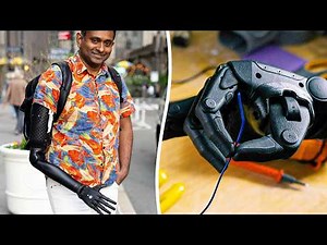 Amputee gets 'world first' whole 3D bionic arm - and can now walk his dog | SWNS