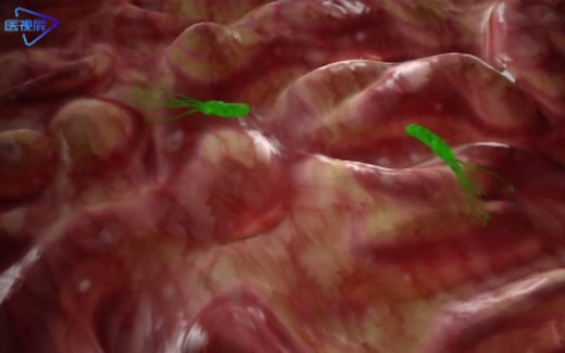 动画演示：幽门螺杆菌