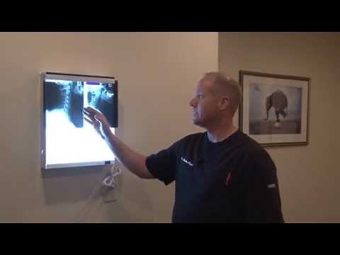 Arthritis in the neck