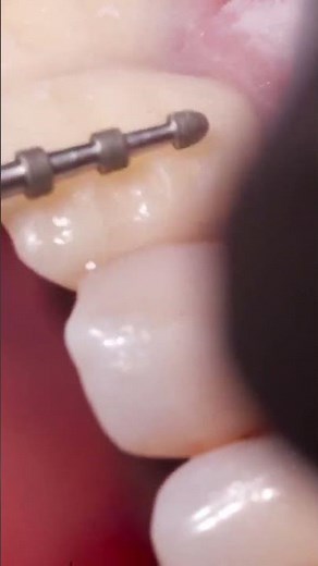 Masterclass on Precision with Diamond Burs