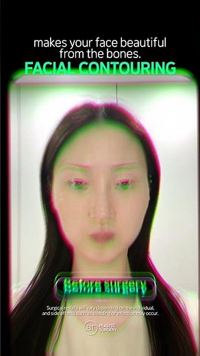 Facial Asymmetry Before and After Korea, Cheekbone Reduction, Genioplasty, V Line Jawline Surgery