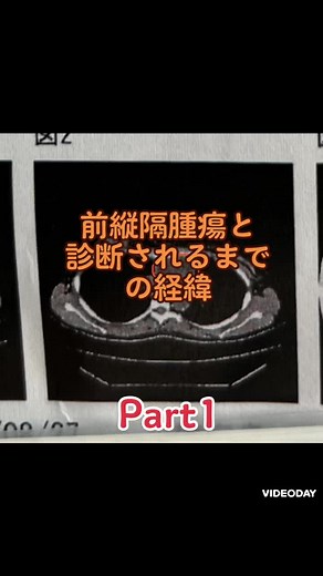 前縦隔腫瘍は、病名ではありません。 縦隔というのが、左右の肺の間の場所を指します。 そこに腫瘍があると発見するまでの私の症状と経緯のはなしです。 #毎年健康診断受けて という呼びかけです。 縦隔腫瘍はほとんど症状がでません。 良性ならなおさら、症状がでません。 パート2か、3くらいでまとめていきます。 #手術 #前縦隔 #腫瘍 #悪性リンパ腫の疑い #胸腺腫 #生検 #息苦しい #やはり横なると痛い #胸が痛い #造影剤ct #ct検査 #大学病院 #家族 #健康診断大事