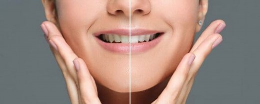 Blanchiment dentaire chez le dentiste : la meilleure méthode blancheur ?