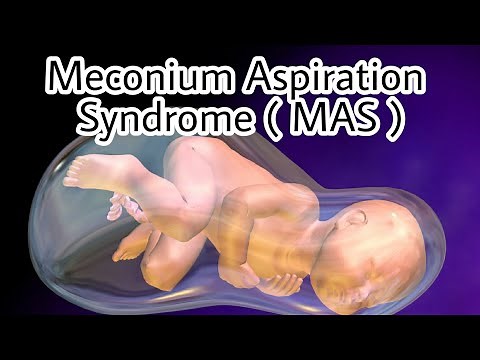 Meconium Aspiration Syndrome | MAS | Symptoms | Causes | Lab Dx | DDx | Management || Mis.Medicine