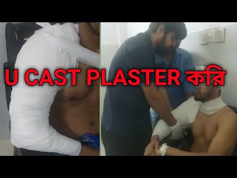 How to apply U cast plaster / Hanging Cast/ U slab for proximal humerus fracture?