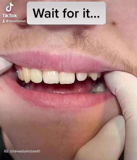 New Partial Denture for Knocked Front Tooth