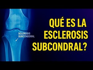 ¿Qué es la esclerosis subcondral?