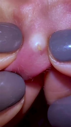 pimples on faces #acne #zits #pimplepop #pimple #fyp