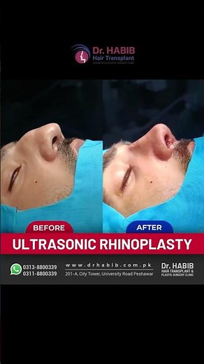 Transformative Rhinoplasty Before and After | Expert Nose Job Results